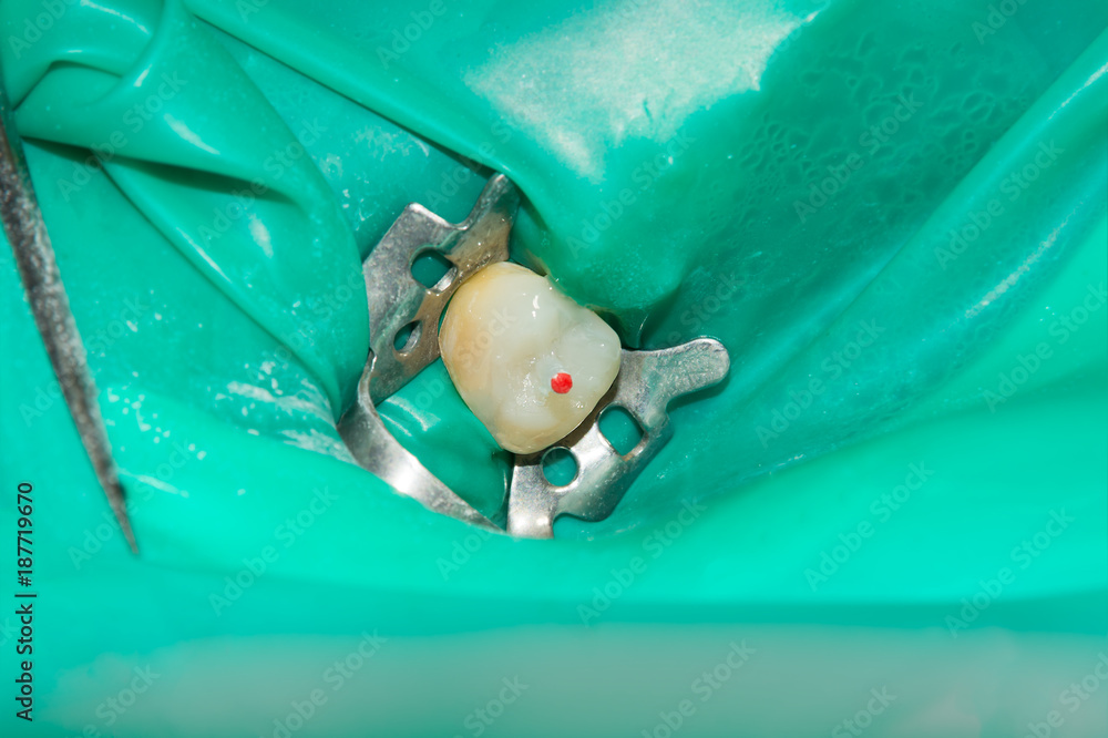 treatment and restoration of rotten carious tooth after root canal