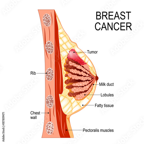 Breast cancer. Cross-section of the mammary gland with tumor.