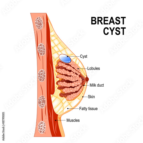 Breast cyst. Women's Health. photo