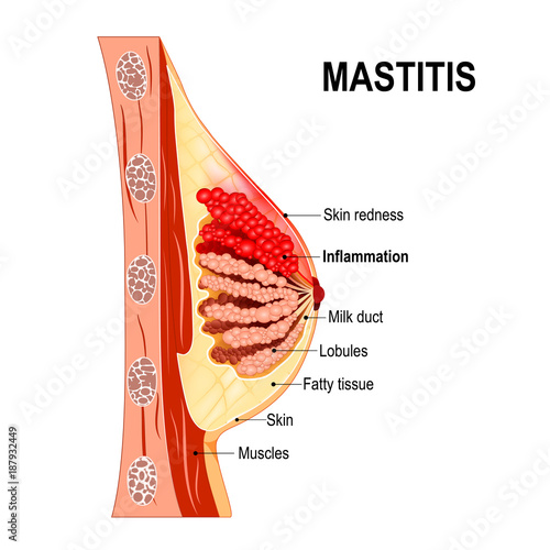 Mastitis. Cross-section of the mammary gland with inflammation of the breast