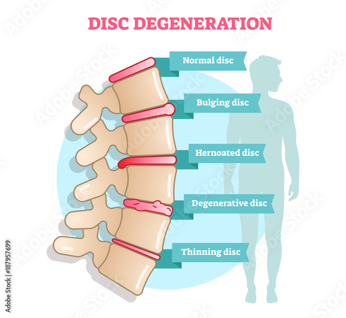 Disc degeneration flat illustration vector diagram with condition exampes - bulging, hernoated, degenerative and thinning disc. Educational medical information.
 photo