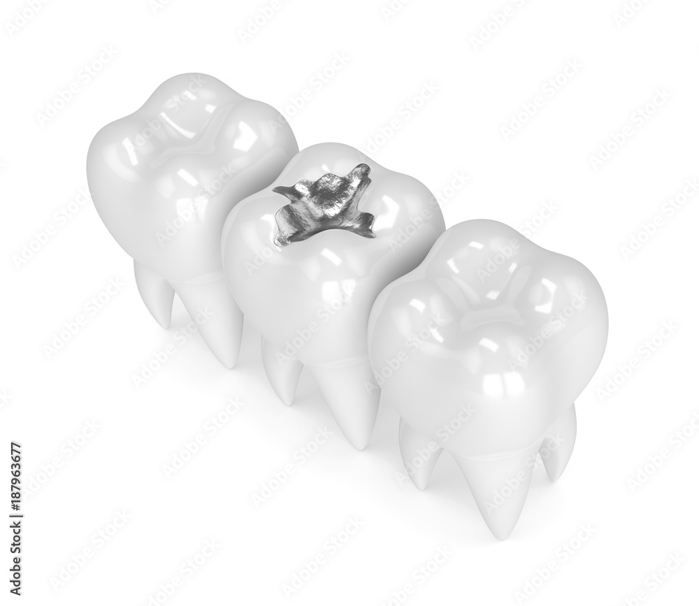 3d render of teeth with dental amalgam filling 3d render of teeth with dental amalgam filling