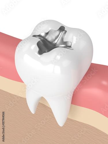 3d render of tooth with dental amalgam filling photo