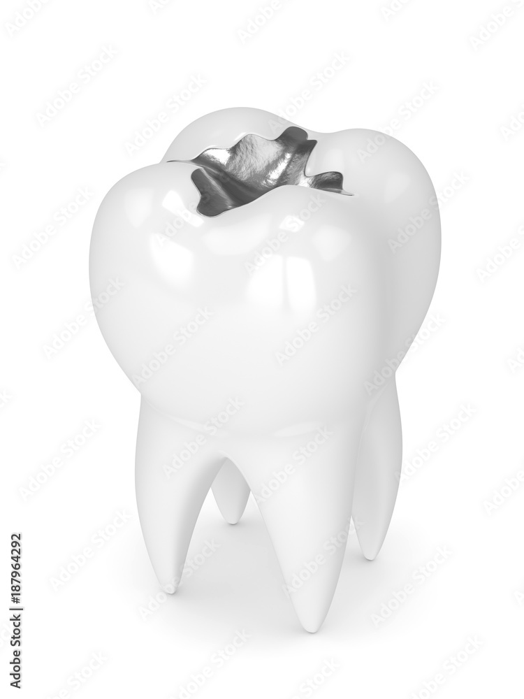 3d render of tooth with dental amalgam filling 3d render of tooth with dental amalgam filling