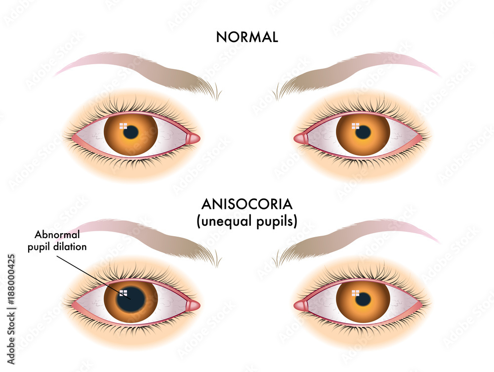 symptoms of unequal pupils called anisocoria Stock Vector Adobe Stock