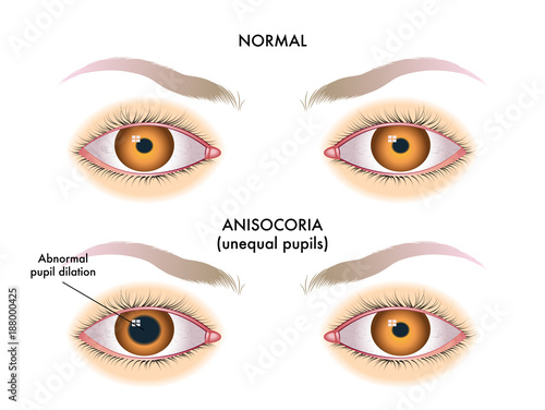 symptoms of unequal pupils called anisocoria