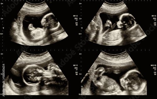 Medical images collage of ultrasound during woman pregnancy showing fetus in third month photo