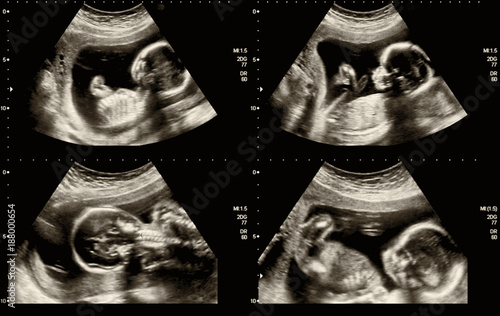 Medical images collage of ultrasound during woman pregnancy showing fetus in third month