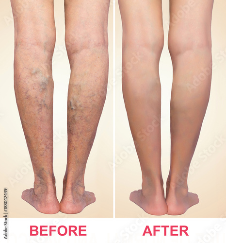 Treatment of varicose before and after. Varicose veins on the legs. photo