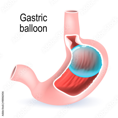 Gastric balloon. inflatable medical device for reduce weight.
