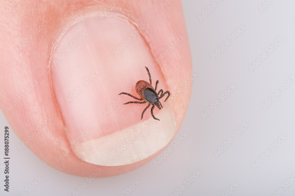 Close-up of tick on human nail. Ixodes ricinus. Dangerous parasite and carrier of infection such as encephalitis and Lyme disease. Close-up of tick on human nail. Ixodes ricinus. Dangerous parasite and carrier of infection such as encephalitis and Lyme disease.