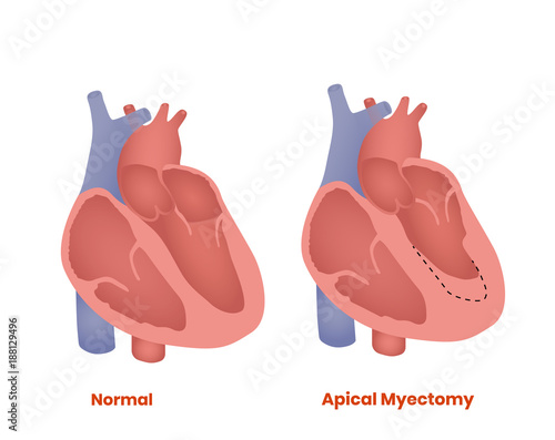 Apical myectomy. Treatment of hypertrophic cardiomyopathy
