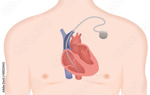 Artificial cardiac pacemaker vector illustration. Implantable Cardioverter Defibrillator photo