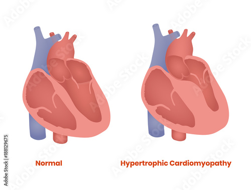 Normal Heart and hypertrophic heart. Hypertrophic Cardiomyopathy vector illustration photo