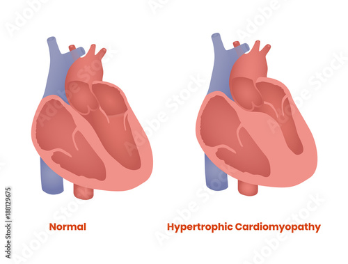 Normal Heart and hypertrophic heart. Hypertrophic Cardiomyopathy vector illustration