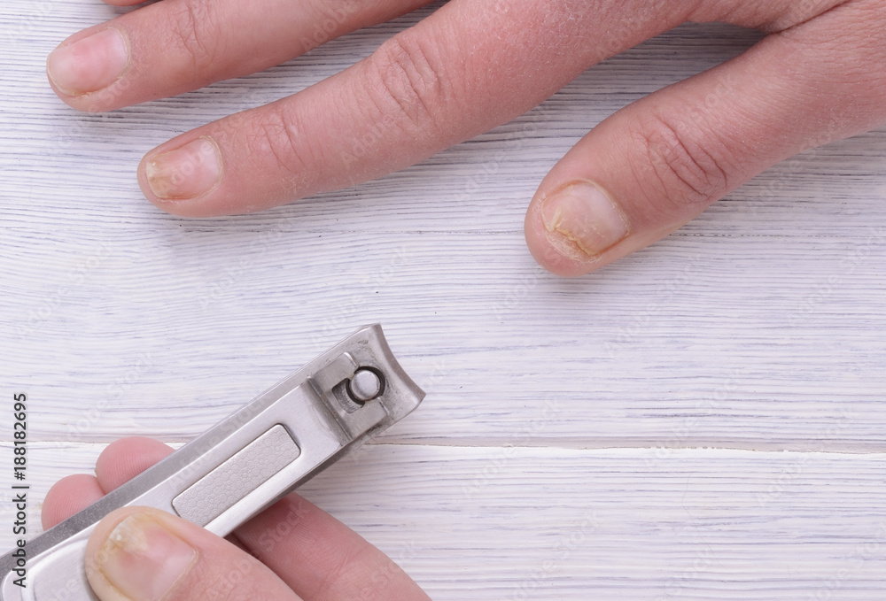 Damage of the nail after using shellac. Onycholysis. Injury of the nail ...