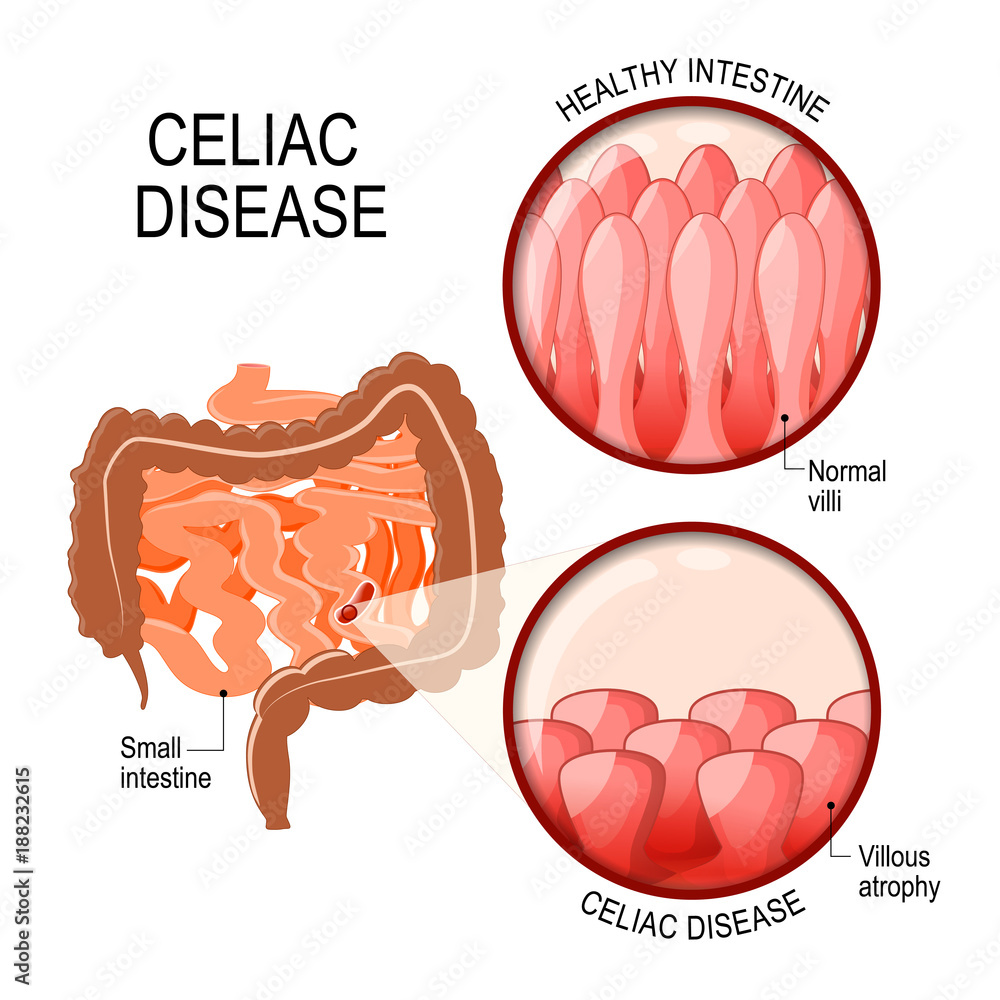 Celiac disease. small intestinal with normal villi, and villous atrophy