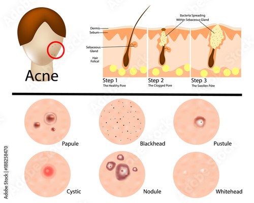 Different types of acne illustration/ Acne stages. Infographic