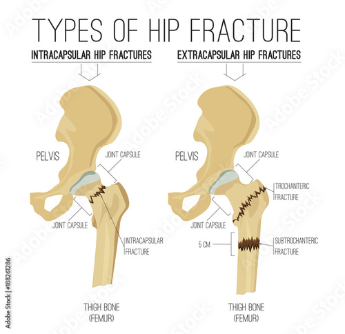 Types of hip fracture