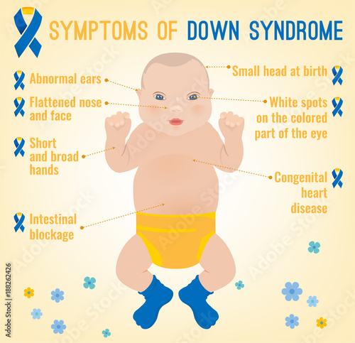 Down Syndrom Symptoms