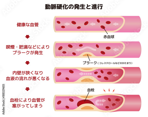 動脈硬化の発生と進行のイラスト