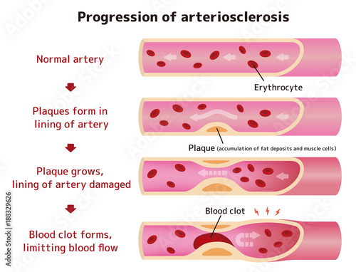 Progression of arteriosclerosis illustration (English)