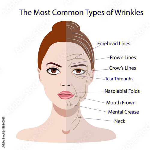 Common Types of Facial Wrinkles. cosmetic surgery. woman facial treatment