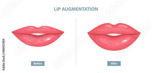 Lip Augmentation. Before and after lip filler injections. Vector illustration