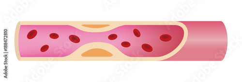 Artery with arteriosclerosis advanced illustration