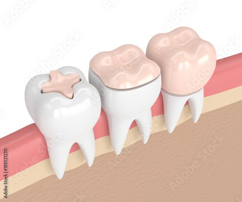 Fototapeta Naklejka Na Ścianę i Meble -  3d render of teeth with different types of dental filling