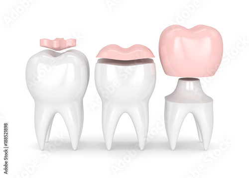 Obraz na plátně 3d render of teeth with different types of filling