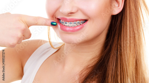 Woman showing her teeth with braces