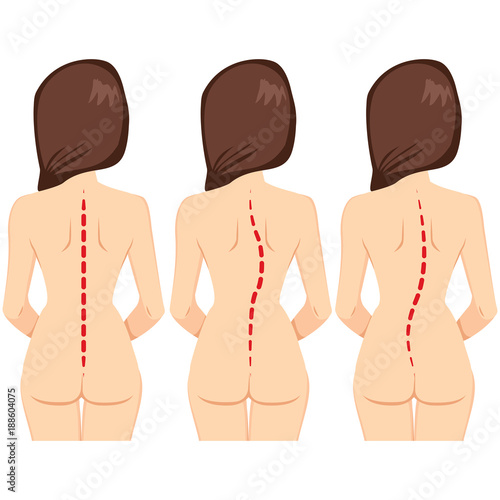Infographic illustration of back view woman representing correct column scoliosis and scale of curvature