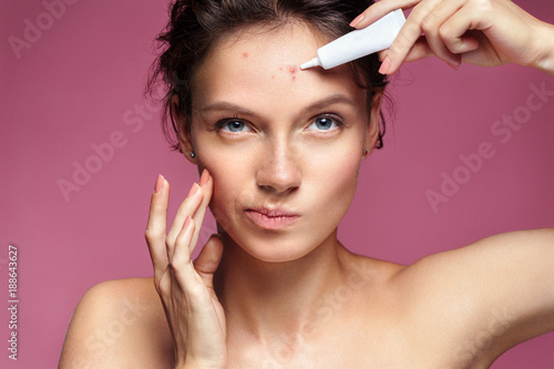 Scowling girl pointing at her acne and applying treatment cream. Photo of young girl with problem skin on pink background. Skin care concept photo