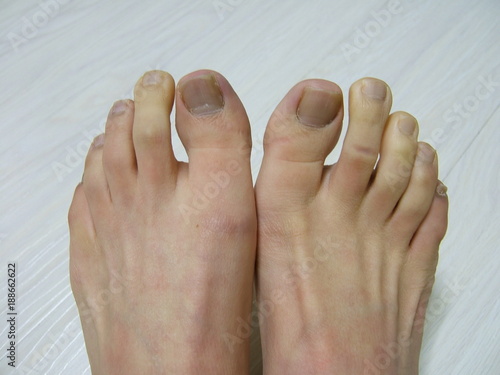  Raynaud syndrome foot photo