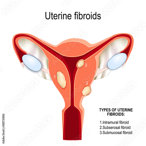 myoma. Human uterus with benign smooth muscle tumors.
