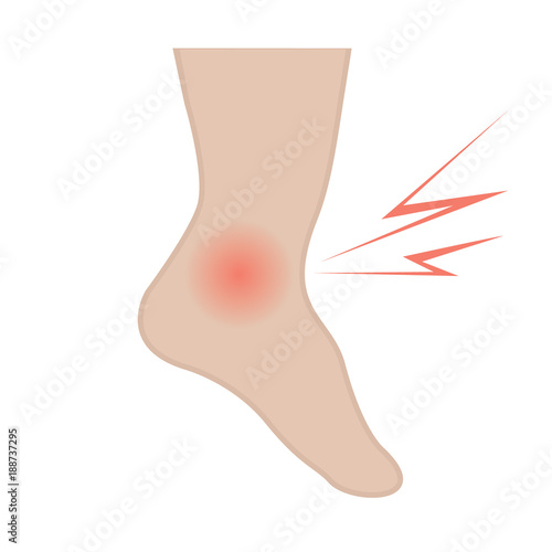 Swelling of the feet and ankles from infected or injury
