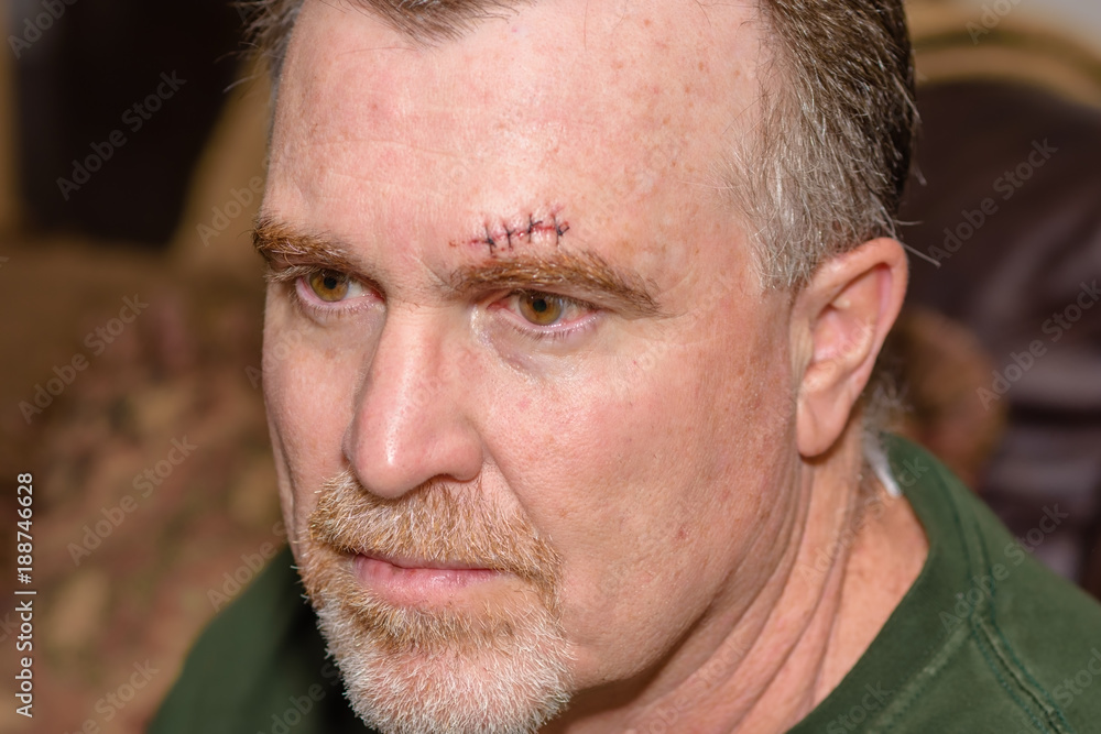 Fototapeta premium Adult male portrait profile with head injury