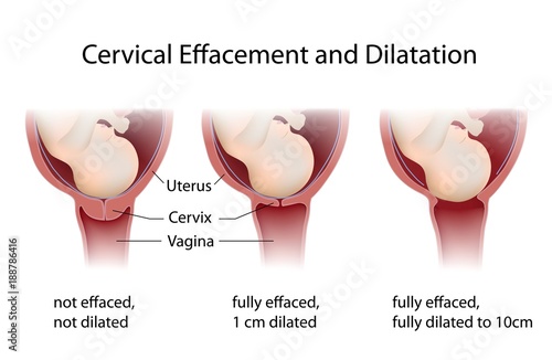 Obraz na plátně Cervical Effacement and Dilatation