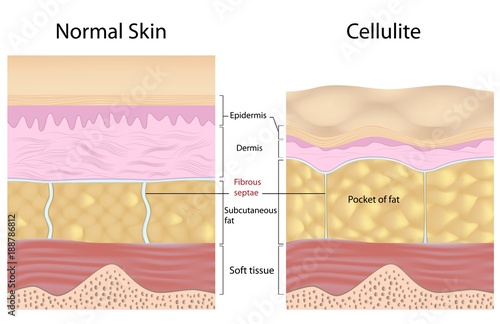 Cellulite versus smooth skin, labeled