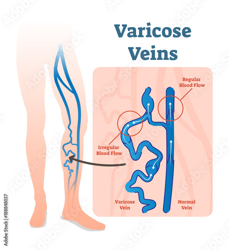 Varicose veins with irregular blood flow and healthy veins vector illustration diagram scheme.  
