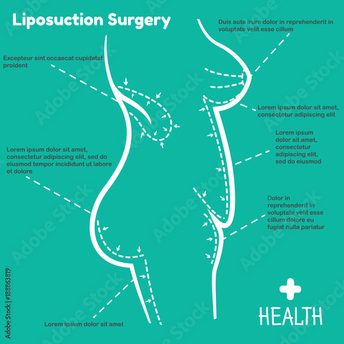 Vector illustration of liposuction surgery. Infographics female body on a blue background