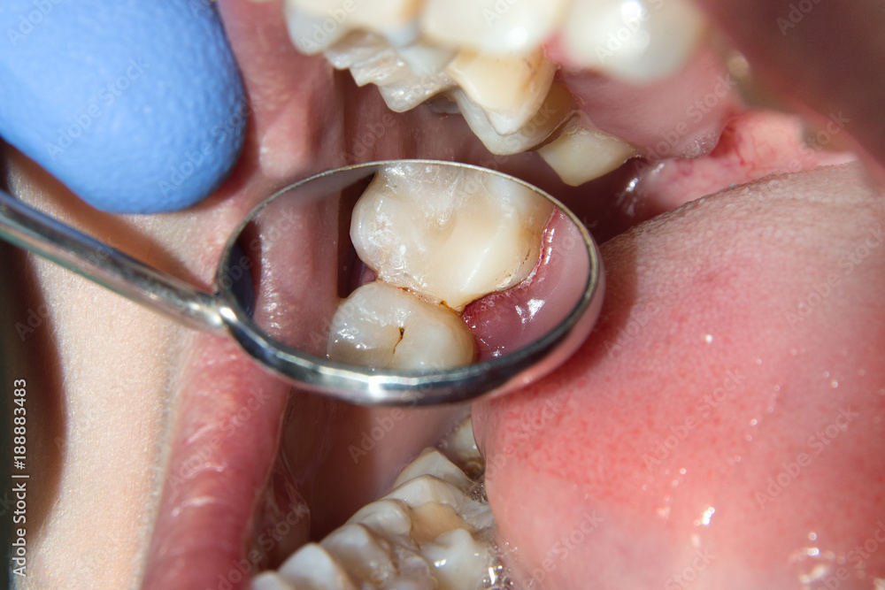 Φωτογραφία treatment and restoration of rotten carious tooth after root canal filling endoc