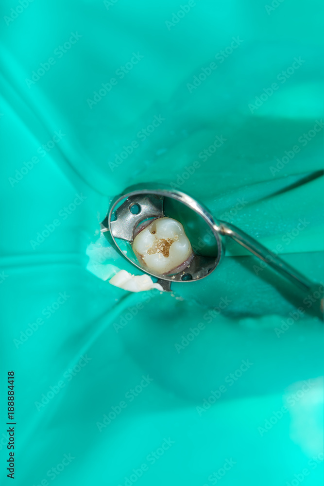 Φωτογραφία treatment and restoration of rotten carious tooth after root canal filling endoc