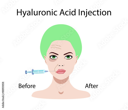 hyaluronic acid injection, before and affect , vector illustration