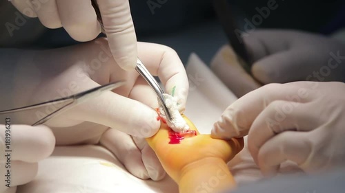 Microsurgeon snips the tissues of a fused child's fingers with surgical scissors close-up 

(1080p, 50fps)
 photo