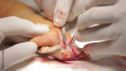 Surgeons make stitches on the finger after the surgery on syndactyly macro (1080p, 50fps)