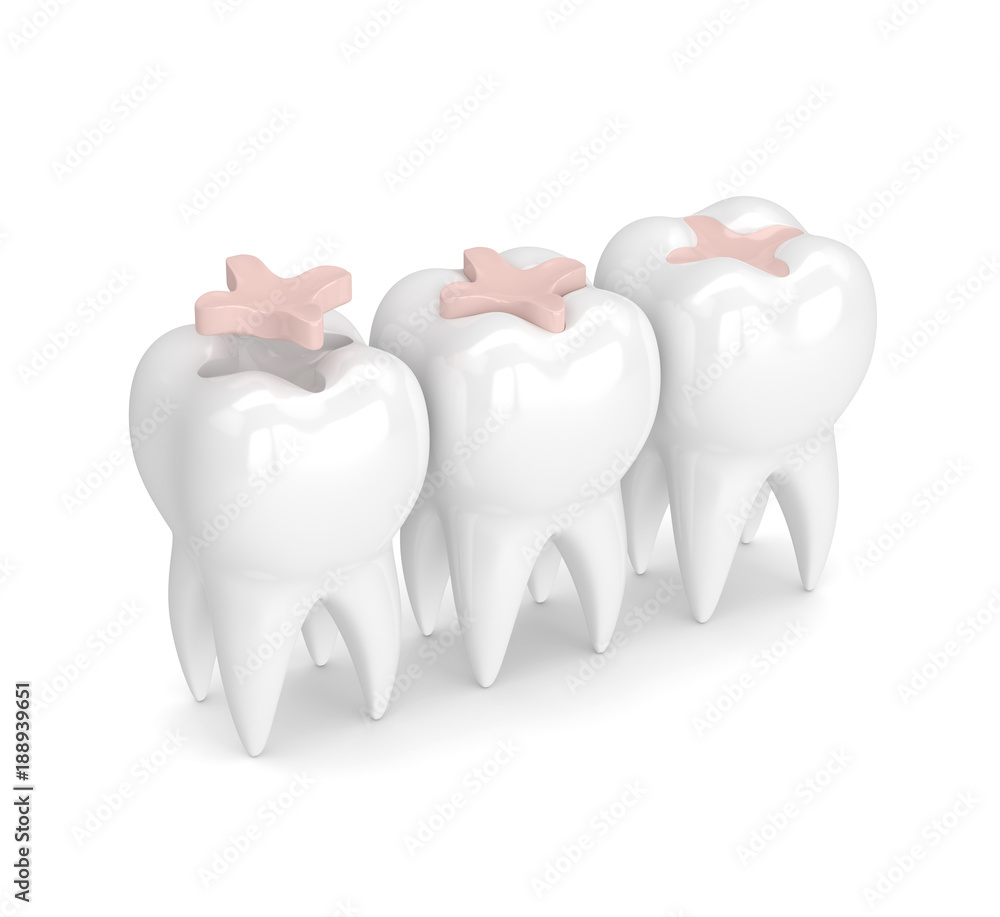 3d render of teeth with dental inlay filling 3d render of teeth with dental inlay filling