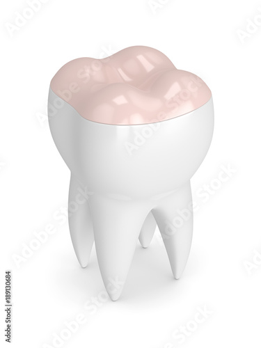 3d render of tooth with dental onlay filling