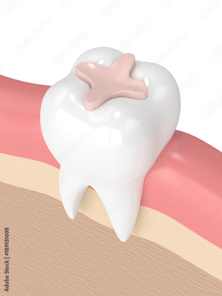 3d render of tooth with dental inlay filling 3d render of tooth with dental inlay filling